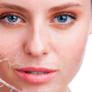 Peeling Chimic